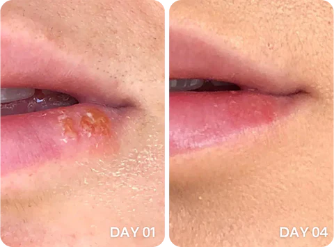 cold sore support oil bottle